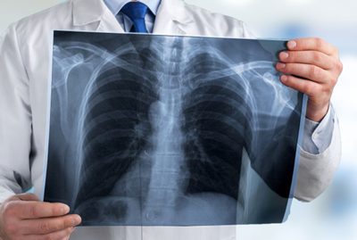 radiografiadme pulmones